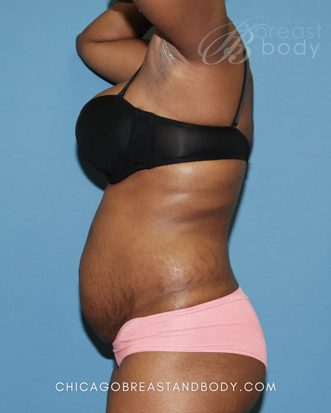 Abdominoplasty (Tummy Tuck) before photo 3, case #480, Dr. Anh-Tuan Truong, Chicago Breast & Body