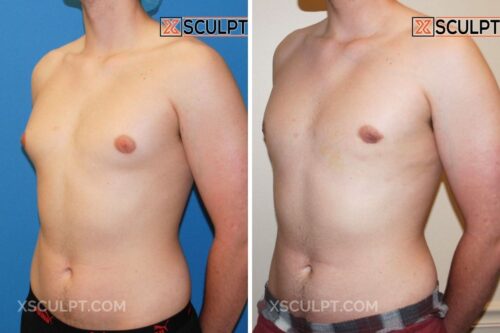 49000 Grade 2 Gynecomastia Dr. Truong Chicago