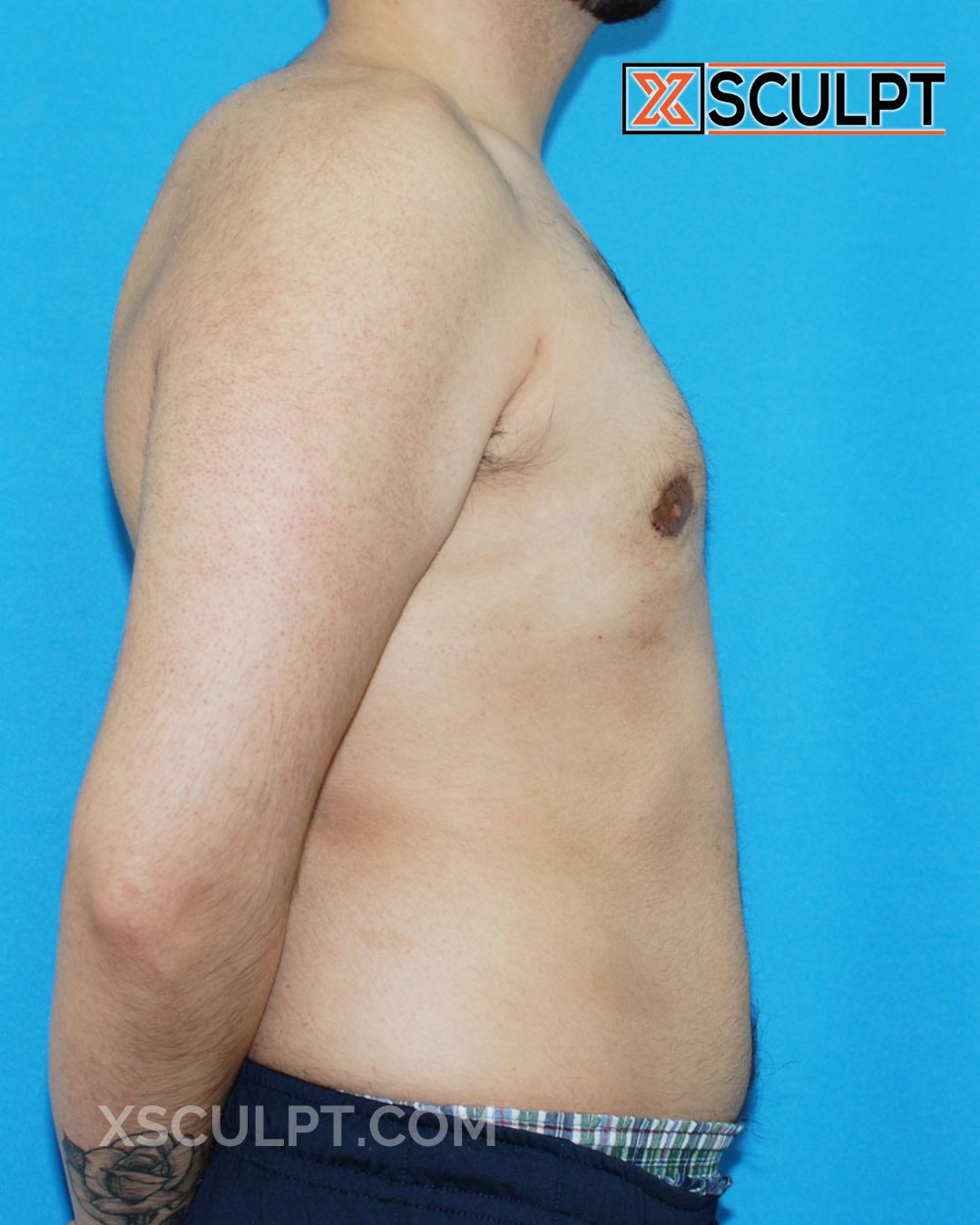 Gynecomastia ChestSculpt™ - Grade 2, Liposuction, Male Breast Reduction after photo 3, case #54000, Dr. Anh-Tuan Truong, Chicago Breast & Body