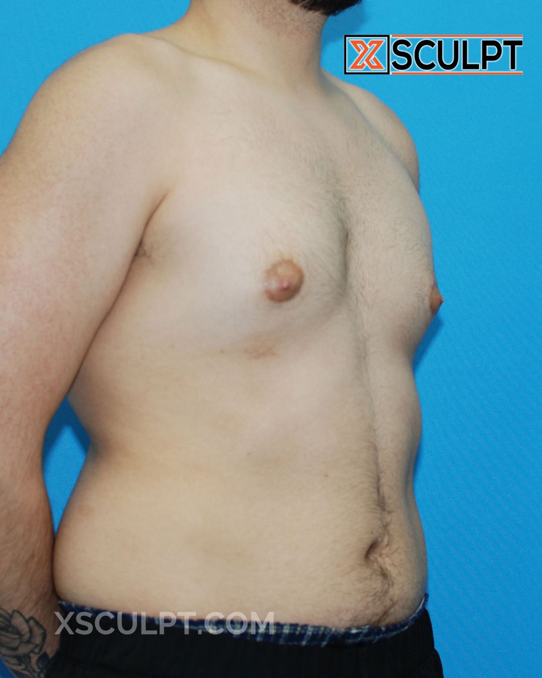 Gynecomastia ChestSculpt™ - Grade 2, Liposuction, Male Breast Reduction before photo 2, case #54000, Dr. Anh-Tuan Truong, Chicago Breast & Body