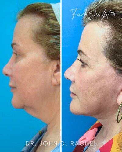 61356 Mini Face Lift by Dr. John Rachel Chicago