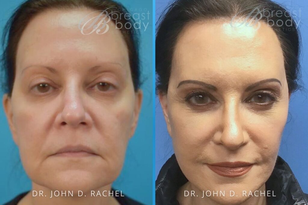 61357 Mini Facelift by Dr. John Rachel Chicago