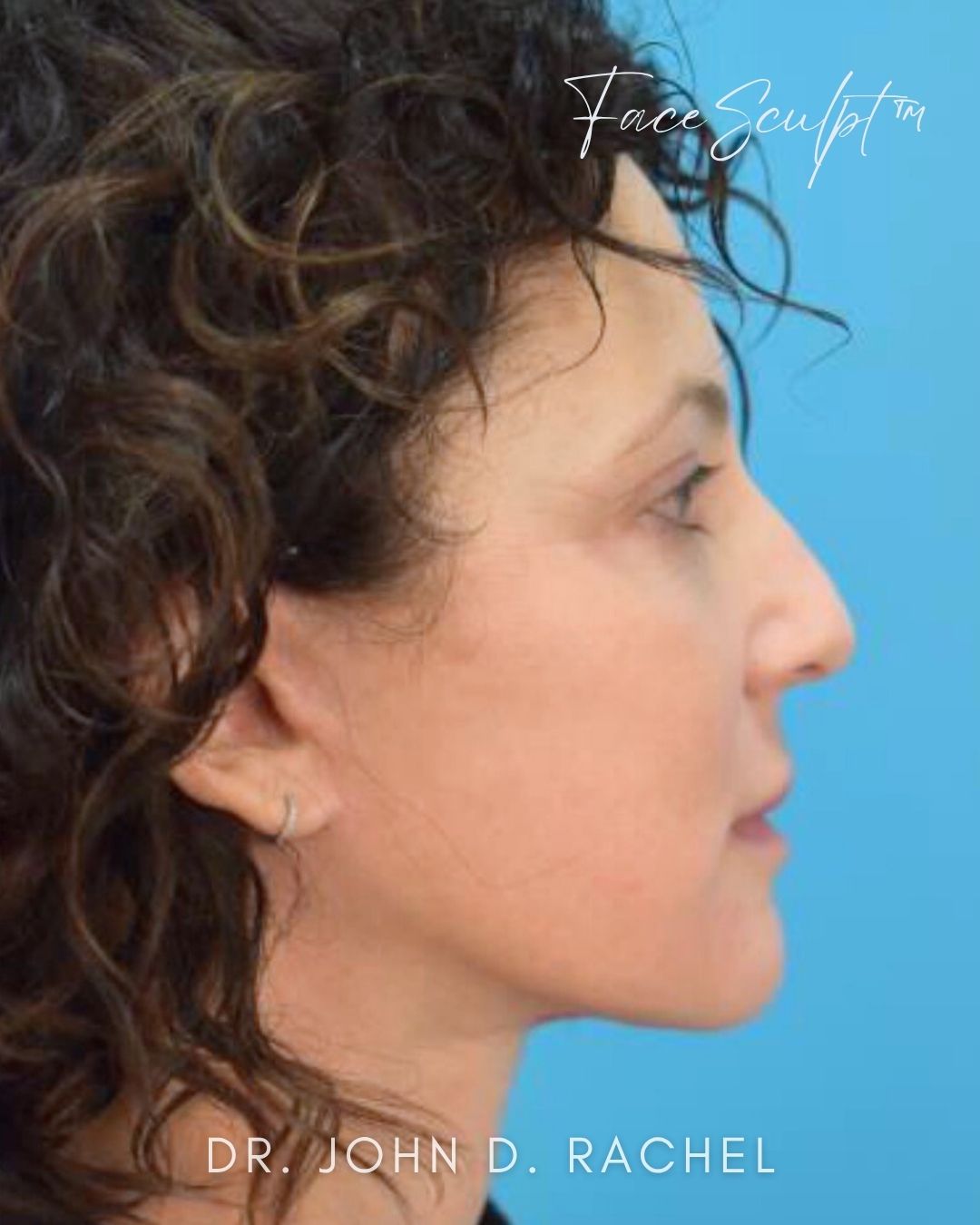 Mini-Facelift after photo 2, case #61358, Dr. John Rachel, Chicago Breast & Body