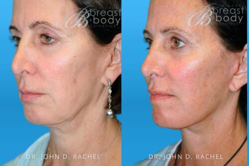 61359 Mini Facelift by Dr. John Rachel Chicago