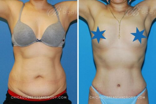 6414 Mommy Makeover Dr. Truong Chicago 3mos