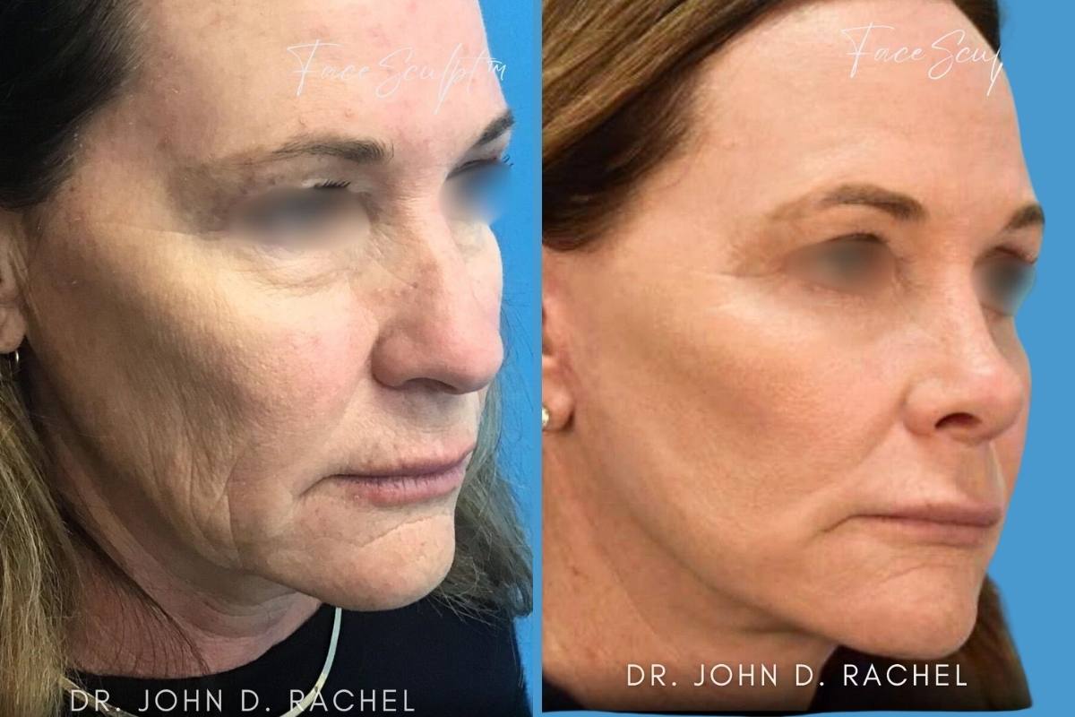 mini face lift by dr john rachel chicago breast and body