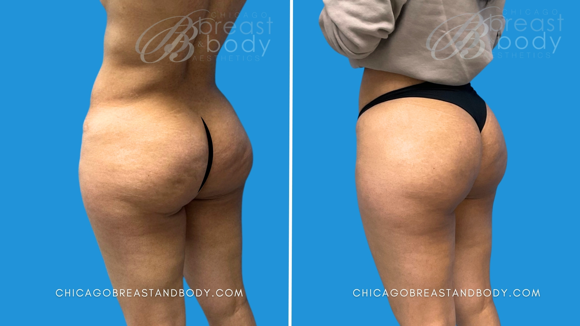 before after photo aveli cellulite buttucks removal after 3 months by chicago breast and body aesthetics
