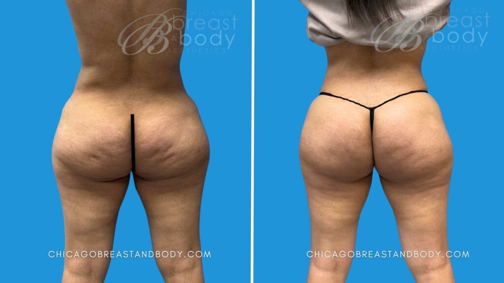 aveli cellulite before and after by Chicago Breast and Body