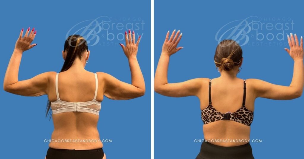1893195 1mo Brachioplasty Arm Lift by Dr. Kevin Lin Chicago Breast and Body