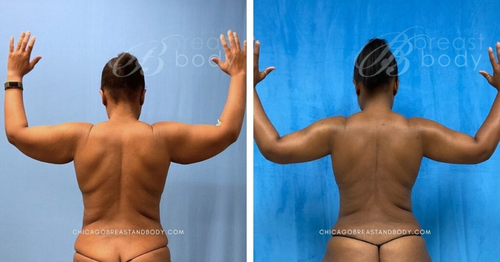 1996527 6mo Brachioplasty Arm Lift by Dr. Kevin Lin Chicago