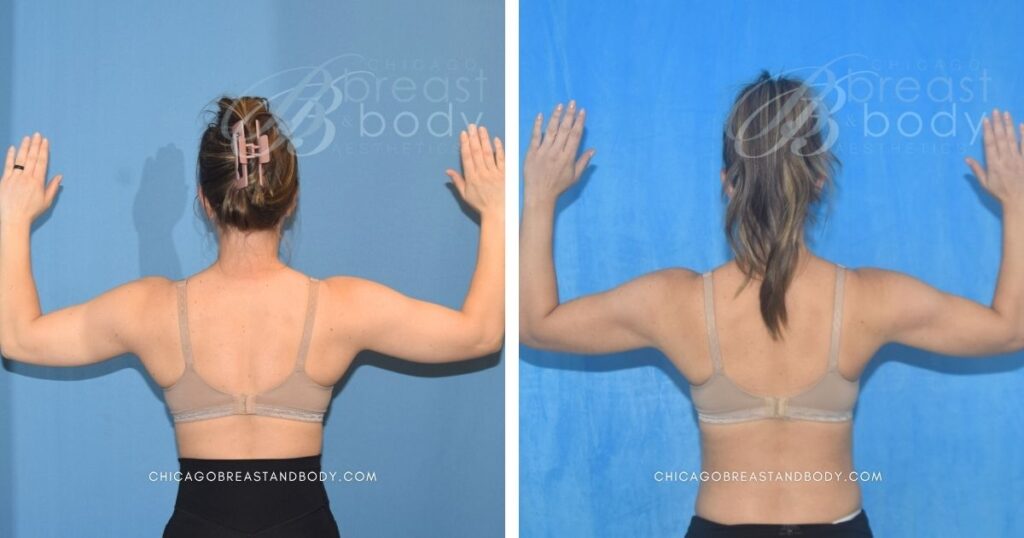 2006202 ArmSculpt Renuvion Arm Lipo Truong