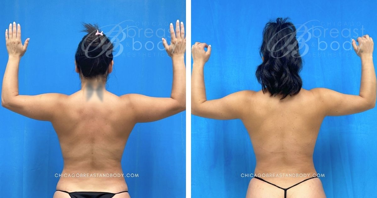 2031217 Armsculpt Renuvion Arm Lipo Truong Chicago Breast And Body