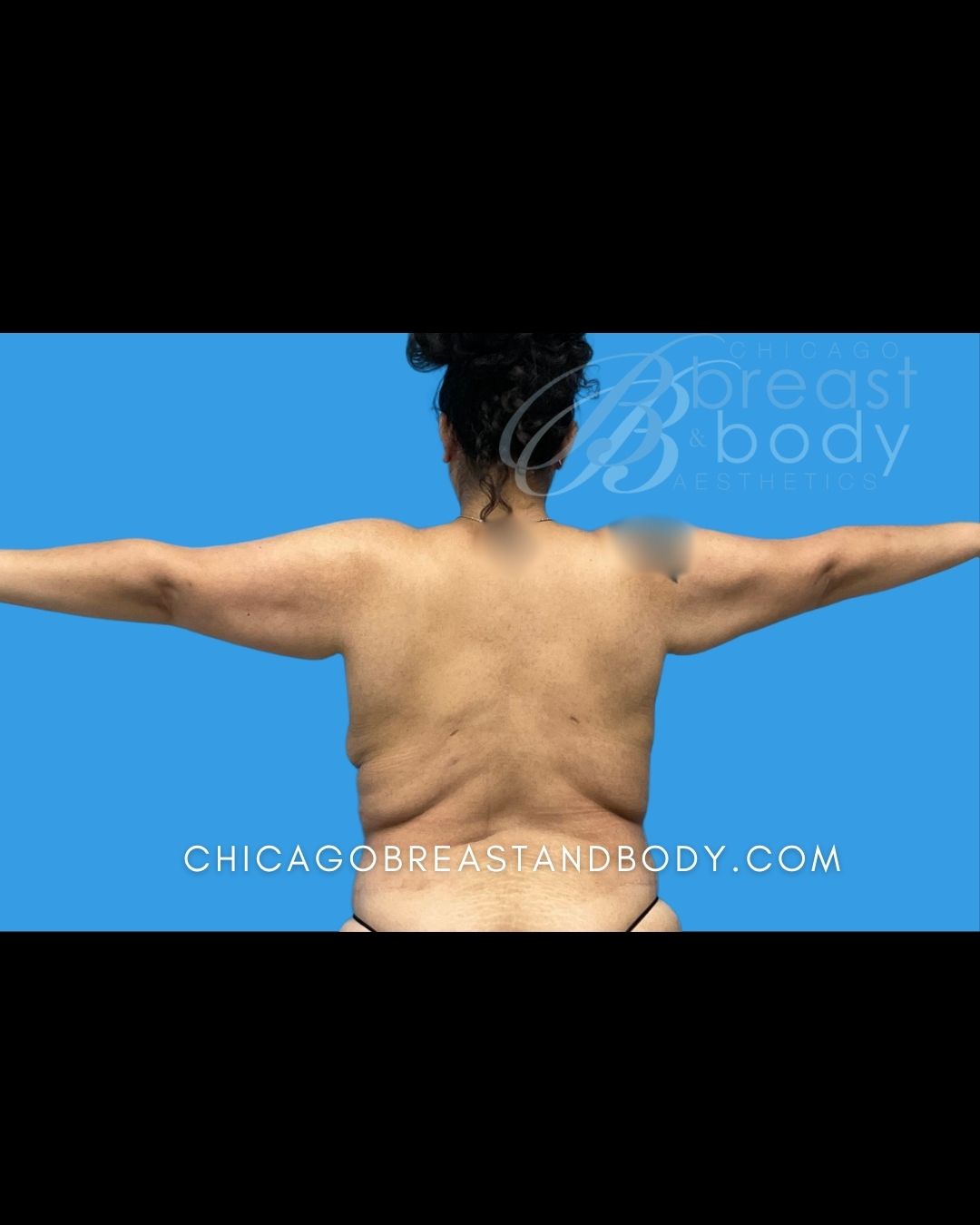 ArmSculpt™ Arm Liposuction, Brachioplasty (Arm Lift) before photo 2, case #2115211, Dr. Kevin Lin, Chicago Breast & Body