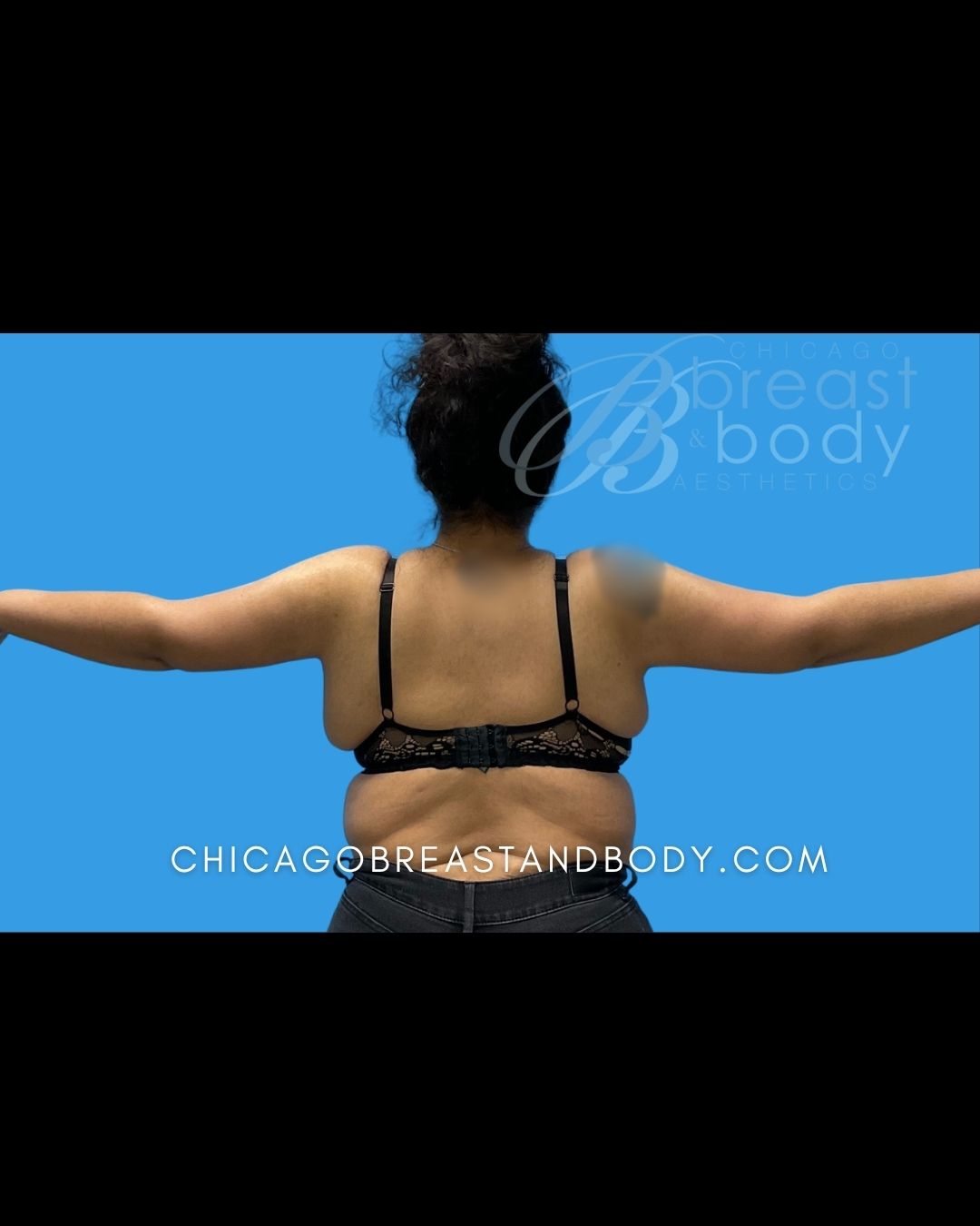 ArmSculpt™ Arm Liposuction, Brachioplasty (Arm Lift) after photo 2, case #2115211, Dr. Kevin Lin, Chicago Breast & Body