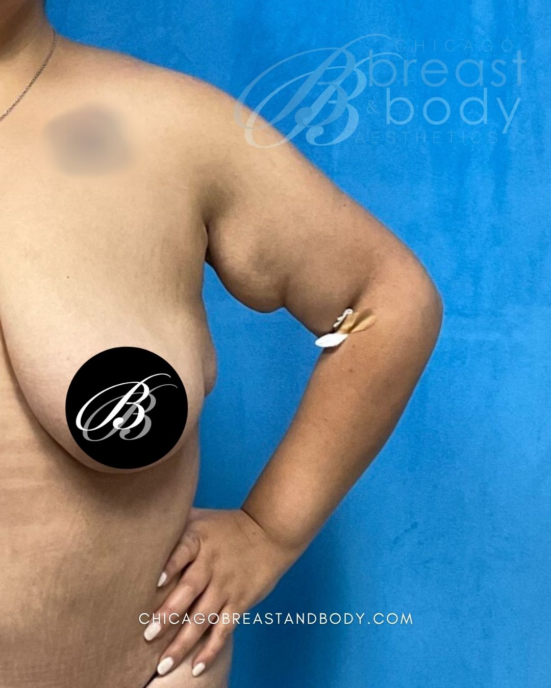 ArmSculpt™ Arm Liposuction, Brachioplasty (Arm Lift) before photo 4, case #2115211, Dr. Kevin Lin, Chicago Breast & Body