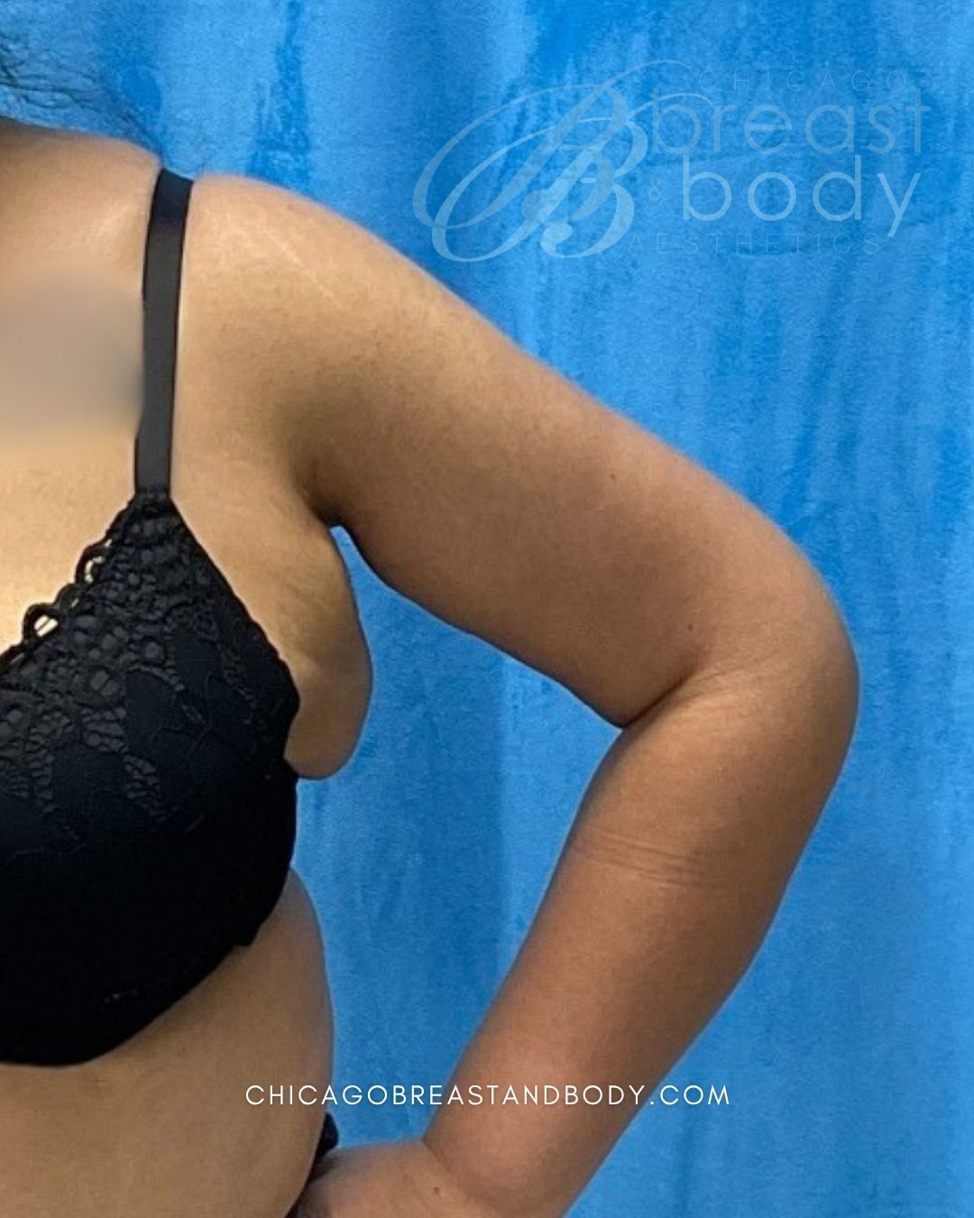 ArmSculpt™ Arm Liposuction, Brachioplasty (Arm Lift) after photo 4, case #2115211, Dr. Kevin Lin, Chicago Breast & Body