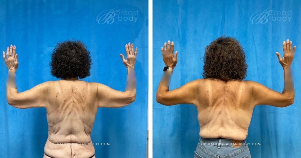2212242 arm lift before after photo by dr kevin lin chicago breast and body