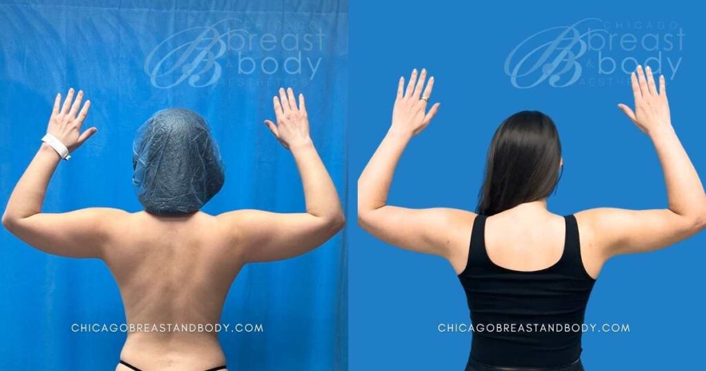 2331786 armsculpt arm liposuction before after photo by dr kevin lin chicago breast and body