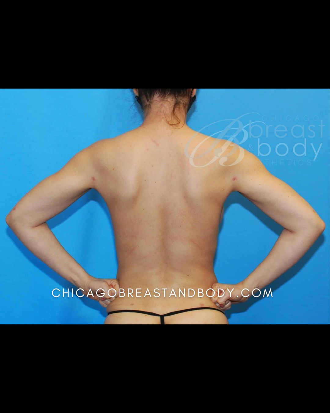 ArmSculpt™ Arm Liposuction, Liposuction, Renuvion (Jplasma) after photo 2, case #11813191, Dr. Anh-Tuan Truong, Chicago Breast & Body