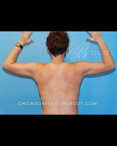 After ArmSculpt arm liposuction with Renuvion photo, case 11813193, patient of Dr. Anh-Tuan Truong, back view with arms raised