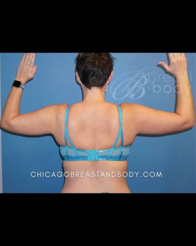 Before ArmSculpt arm liposuction with Renuvion photo, case 11813193, patient of Dr. Anh-Tuan Truong, back view with arms raised