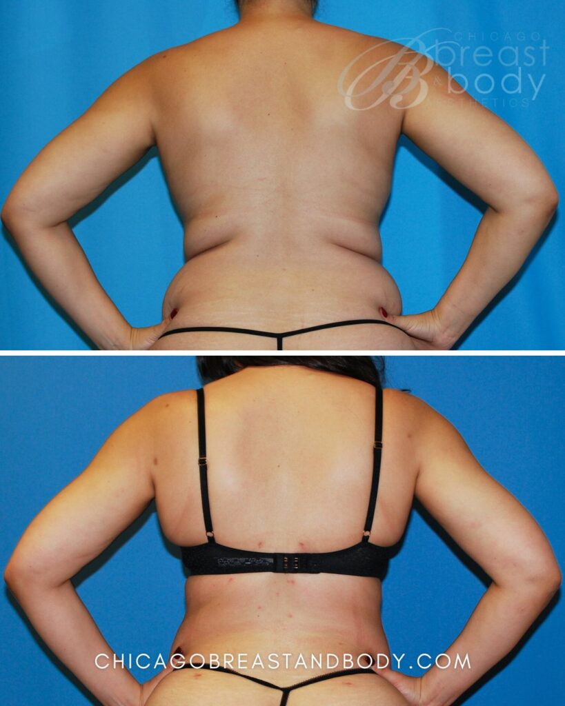1234898-Arm-Liposuction-by-Dr.-Anh-Tuan-Truong-2months