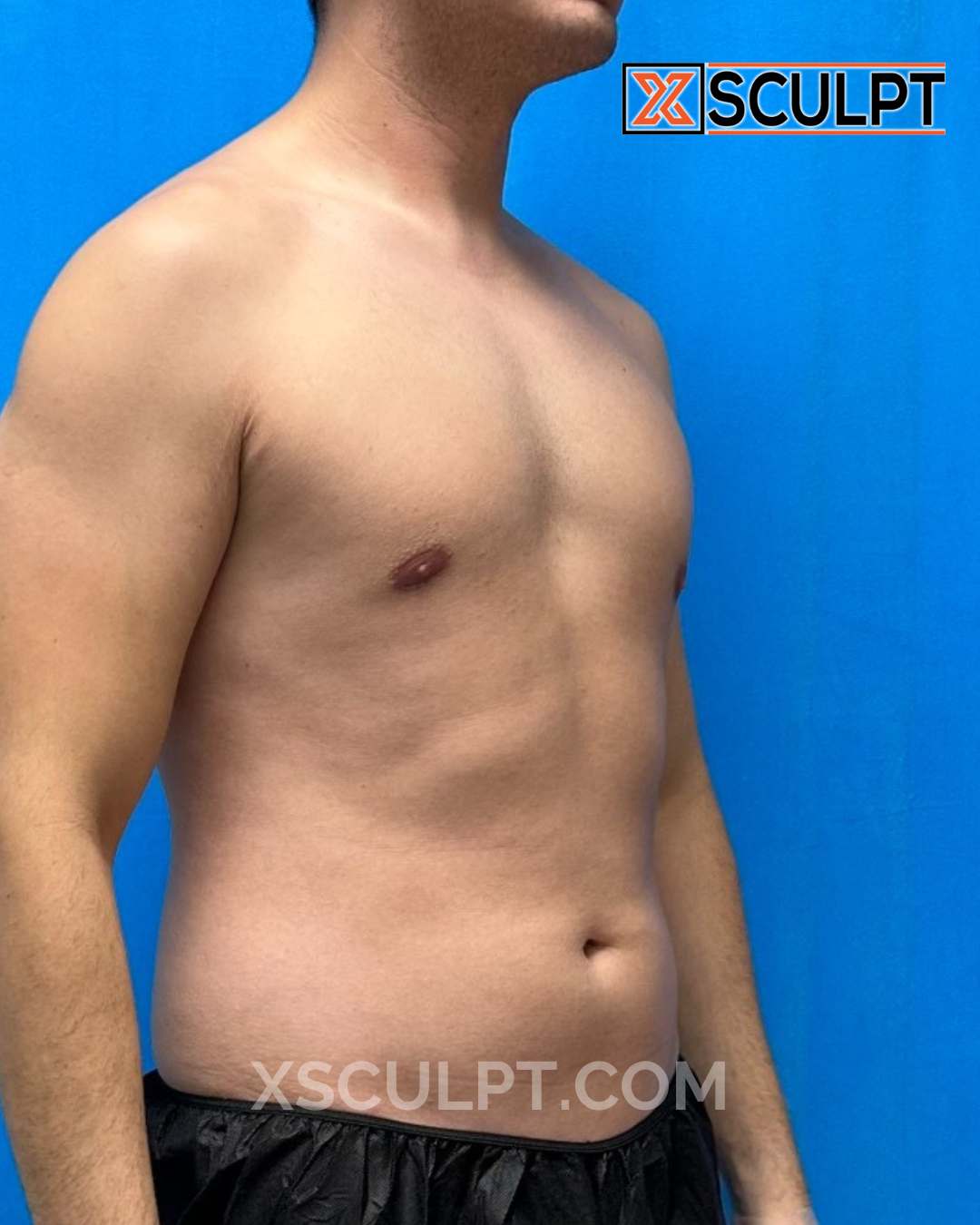 Abdominal Etching, AbSculpt™ Abdominal Etching, Lipo 360 before photo 2, case #1638367, Dr. Anh-Tuan Truong, Chicago Breast & Body