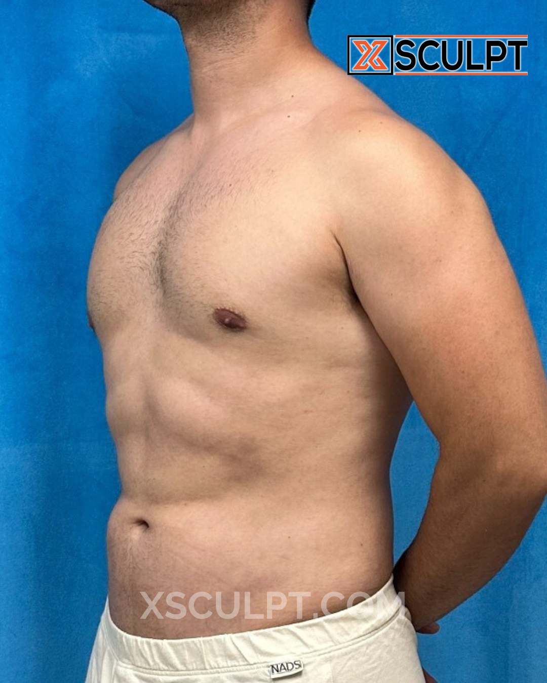 Abdominal Etching, AbSculpt™ Abdominal Etching, Lipo 360 after photo 3, case #1638367, Dr. Anh-Tuan Truong, Chicago Breast & Body