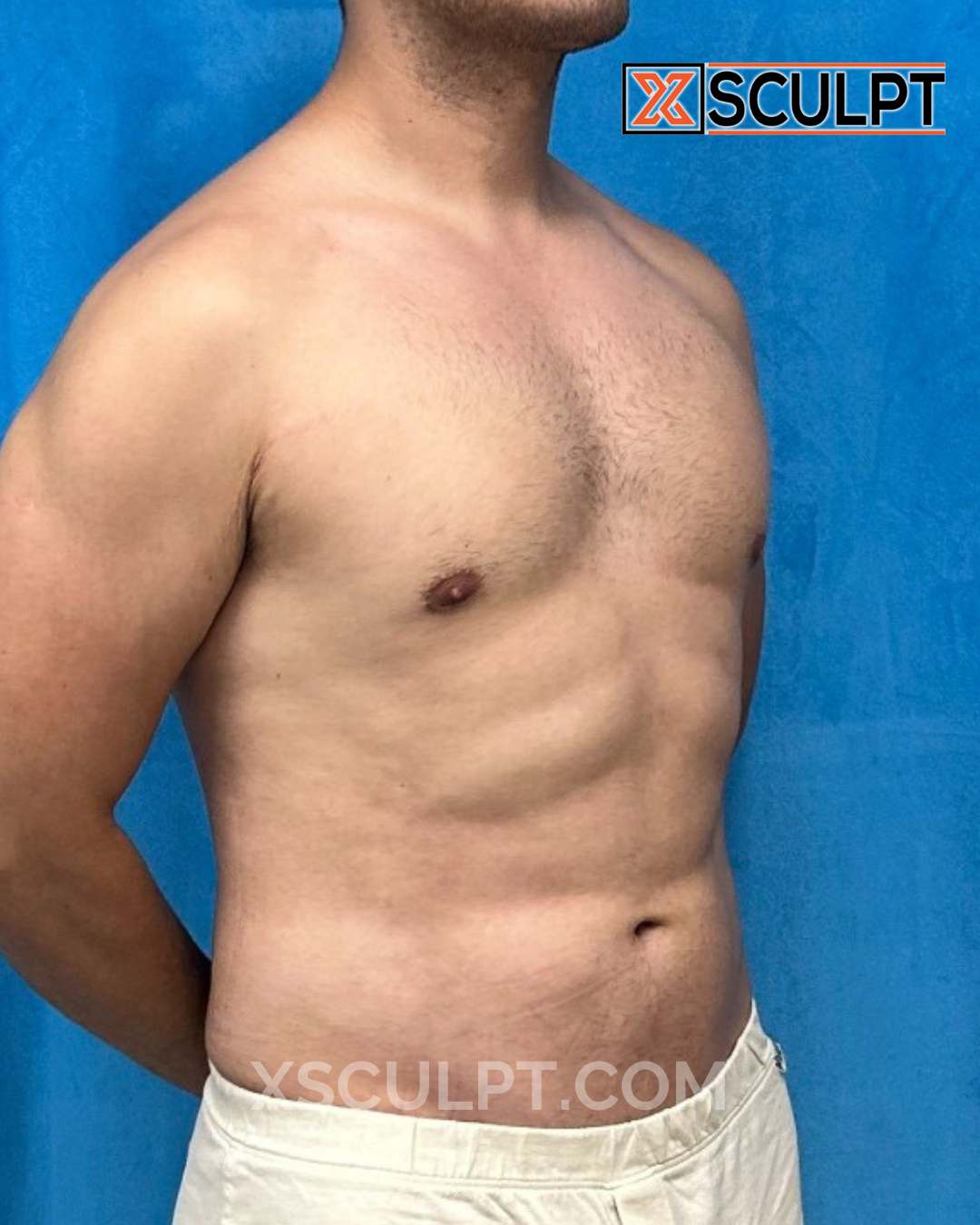 Abdominal Etching, AbSculpt™ Abdominal Etching, Lipo 360 after photo 2, case #1638367, Dr. Anh-Tuan Truong, Chicago Breast & Body