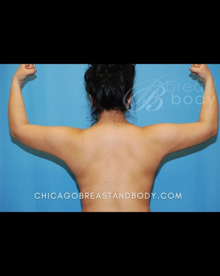 After ArmSculpt arm liposuction photo, case 1681297, patient of Dr. Anh-Tuan Truong, back view, arms raised