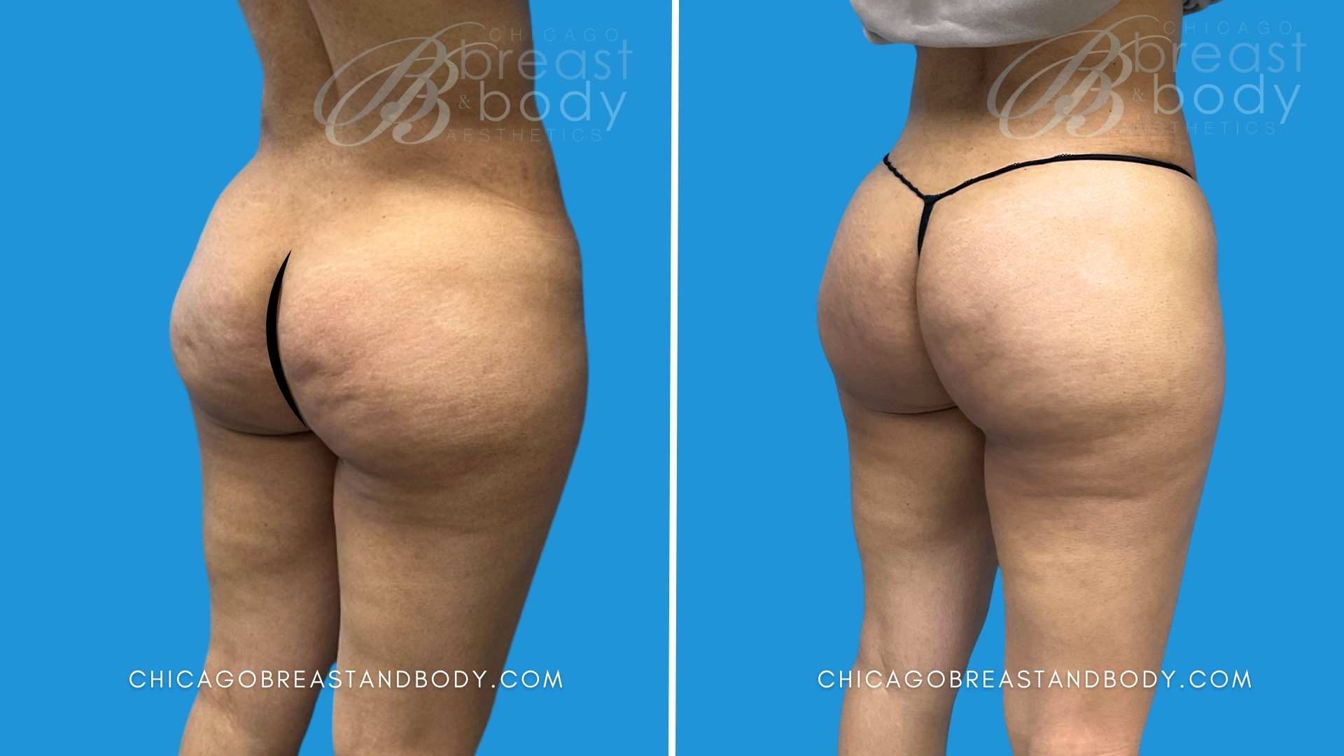 1748705 Aveli Cellulite After 3 months Dr. Kevin Lin Chicago