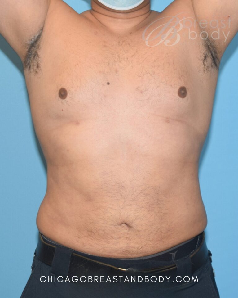 After Lipo 360, front view, 7 months after surgery, case 1755414, patient of Dr. Anh-Tuan Truong
