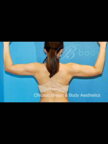 After ArmSculpt arm liposuction photo, case 1780466, patient of Dr. Anh-Tuan Truong, back view with arms raised