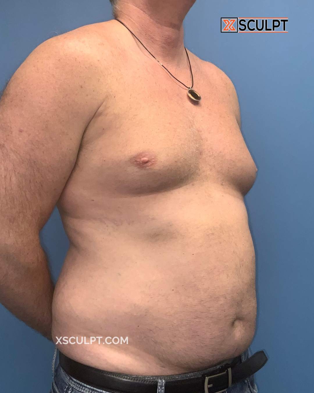 Gynecomastia ChestSculpt™ - Grade 3, Lipo 360, Liposuction before photo 2, case #1847583, Dr. Marc Adajar, Chicago Breast & Body