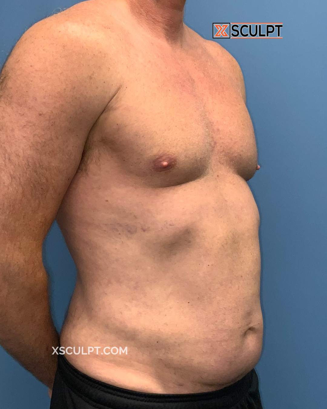 Gynecomastia ChestSculpt™ - Grade 3, Lipo 360, Liposuction after photo 2, case #1847583, Dr. Marc Adajar, Chicago Breast & Body