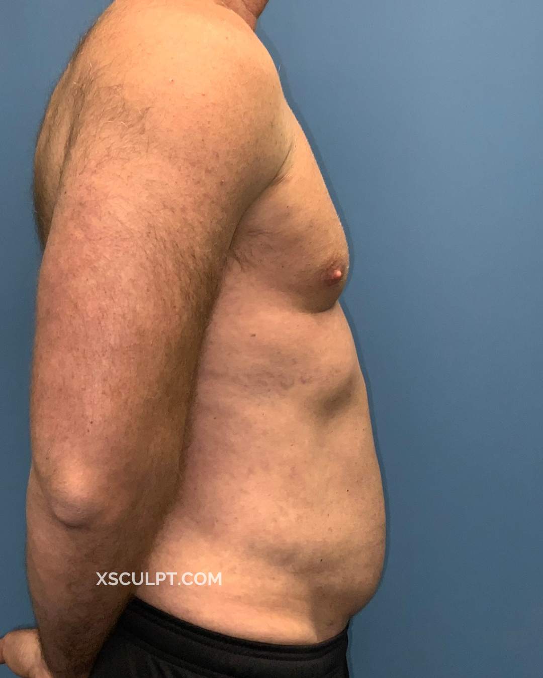 Gynecomastia ChestSculpt™ - Grade 3, Lipo 360, Liposuction after photo 3, case #1847583, Dr. Marc Adajar, Chicago Breast & Body