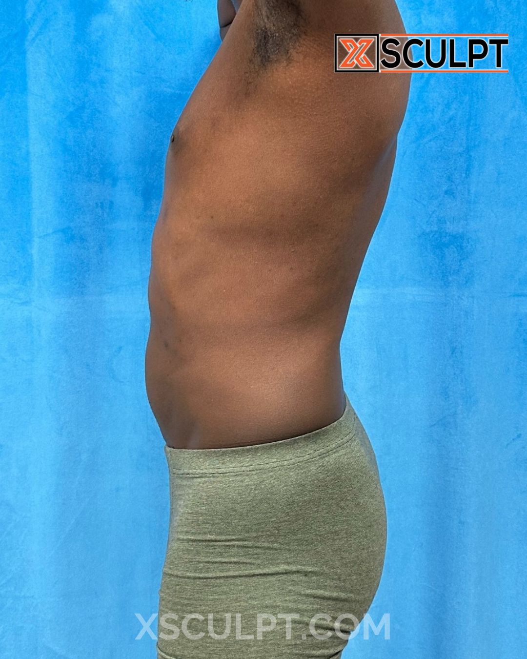 AbSculpt™ Abdominal Etching, Lipo 360, Liposuction after photo 3, case #2025265, Dr. Anh-Tuan Truong, Chicago Breast & Body