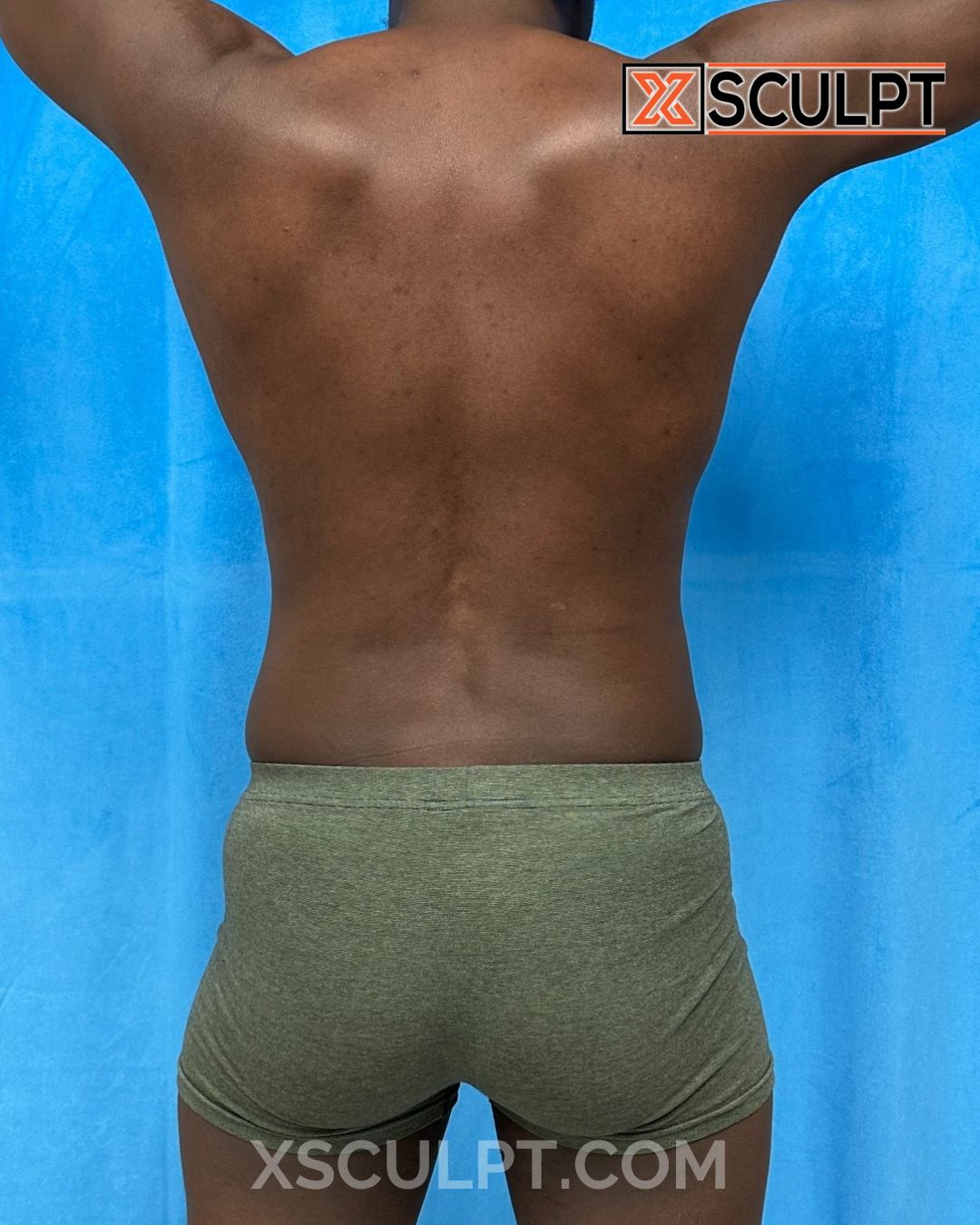 AbSculpt™ Abdominal Etching, Lipo 360, Liposuction after photo 4, case #2025265, Dr. Anh-Tuan Truong, Chicago Breast & Body