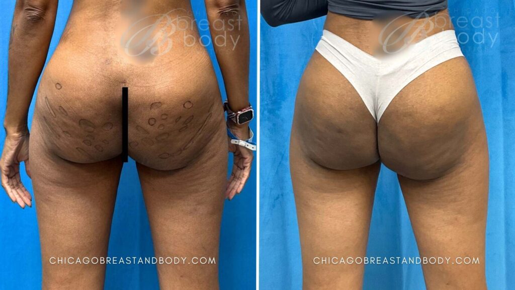 Before after photo 2255629 Aveli Cellulite Dr. Kevin Lin 3 months Chicago