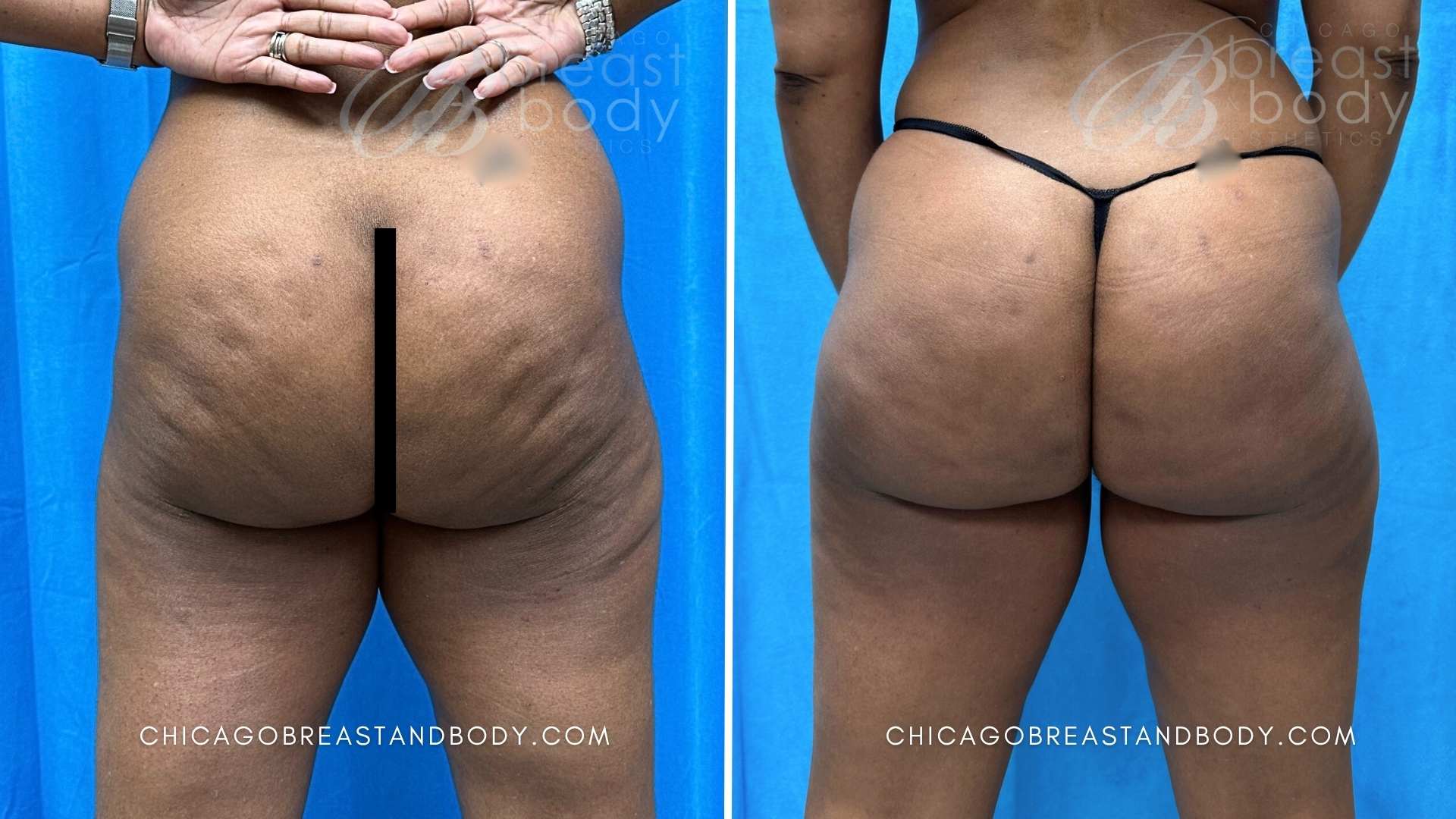 Before After Photo 2290493 Aveli Cellulite Dr. Anh Tuan Truong Chicago