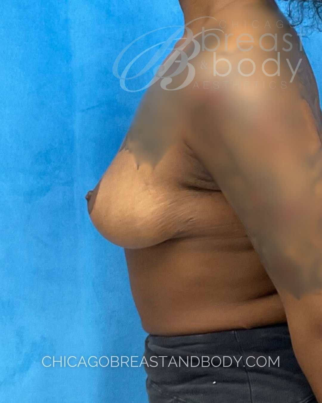 Breast Lift (Mastopexy) after photo 3, case #2323731, Dr. Kevin Lin, Chicago Breast & Body