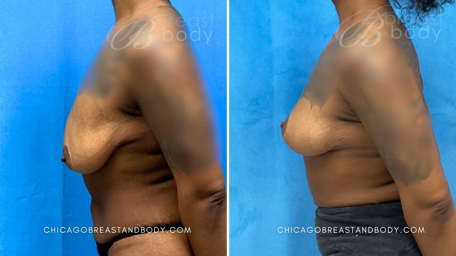 Before After Photo 2323731 Breast Lift Mastopexy 3 months Dr Kevin Lin Chicago
