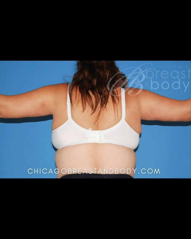 After Brachioplasty arm lift with ArmSculpt photo, case 253, patient of Dr. Anh-Tuan Truong, back view, arms out