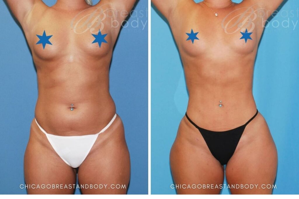 941 Bbl Hip Augmentation By Dr. Anh Tuan Truong