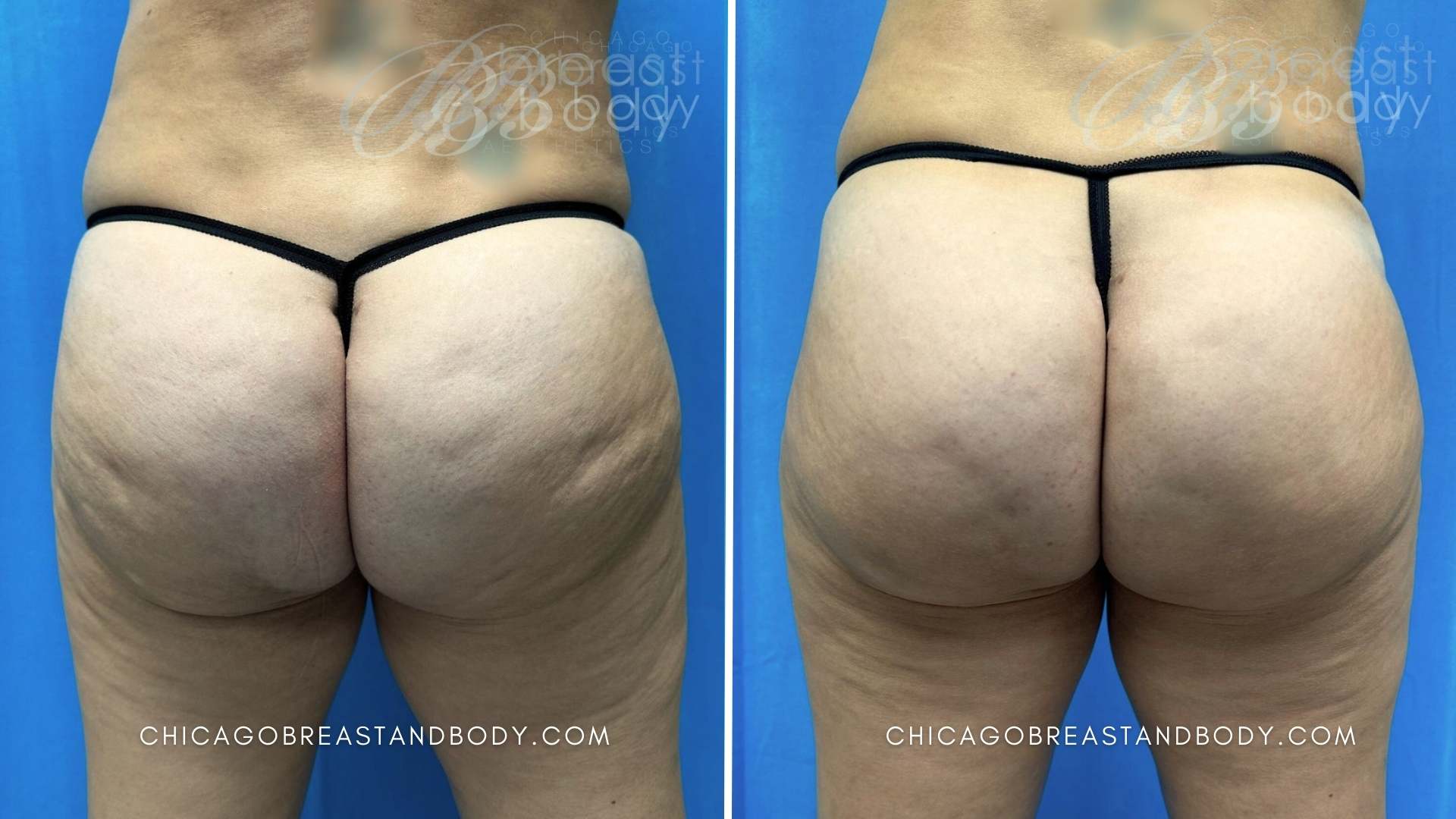 951972 Aveli Cellulite Dr. Anh Tuan Truong 6 weeks Chicago