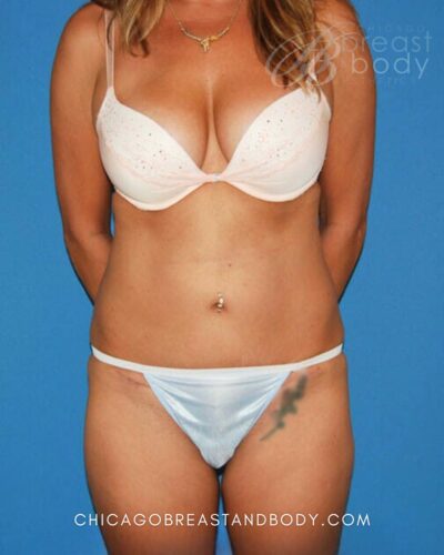Mini tummy tuck after photo, case 131, actual patient of Dr. Anh-Tuan Truong in Chicago