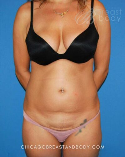 Mini tummy tuck before photo, case 131, actual patient of Dr. Anh-Tuan Truong in Chicago