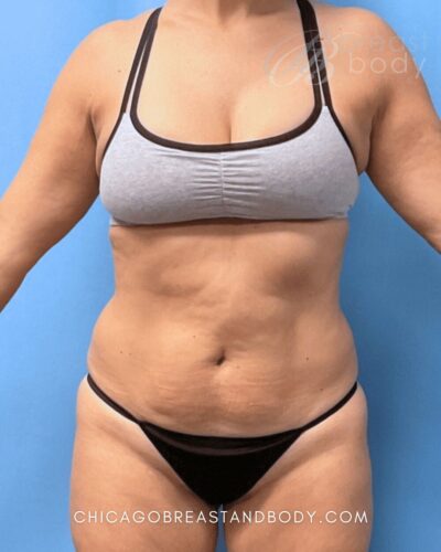 Mini tummy tuck before photo, case 1835256, actual patient of Dr. Kevin Lin in Chicago