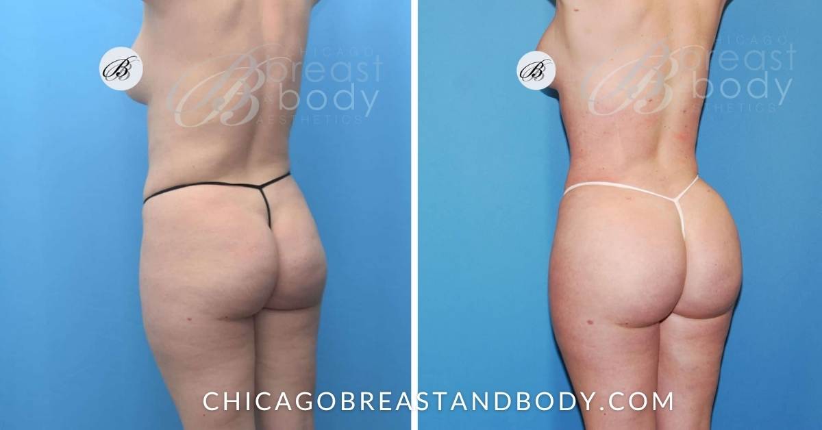 1511908 BBL & Hip Augmentation by Dr. Anh Tuan Truong 2mos