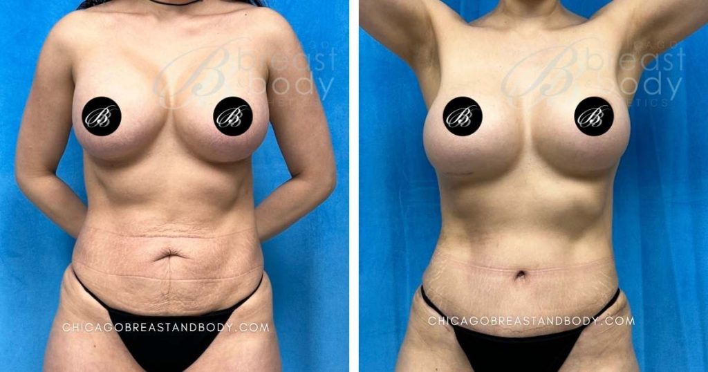 How Much Does A Tummy Tuck Cost In Chicago? | Chicago Breast And Body Aesthetics Before After Photo of Mini Tummy Tuck with Liposuction 3 months Dr Anh Tuan Truong Chicago 1560090